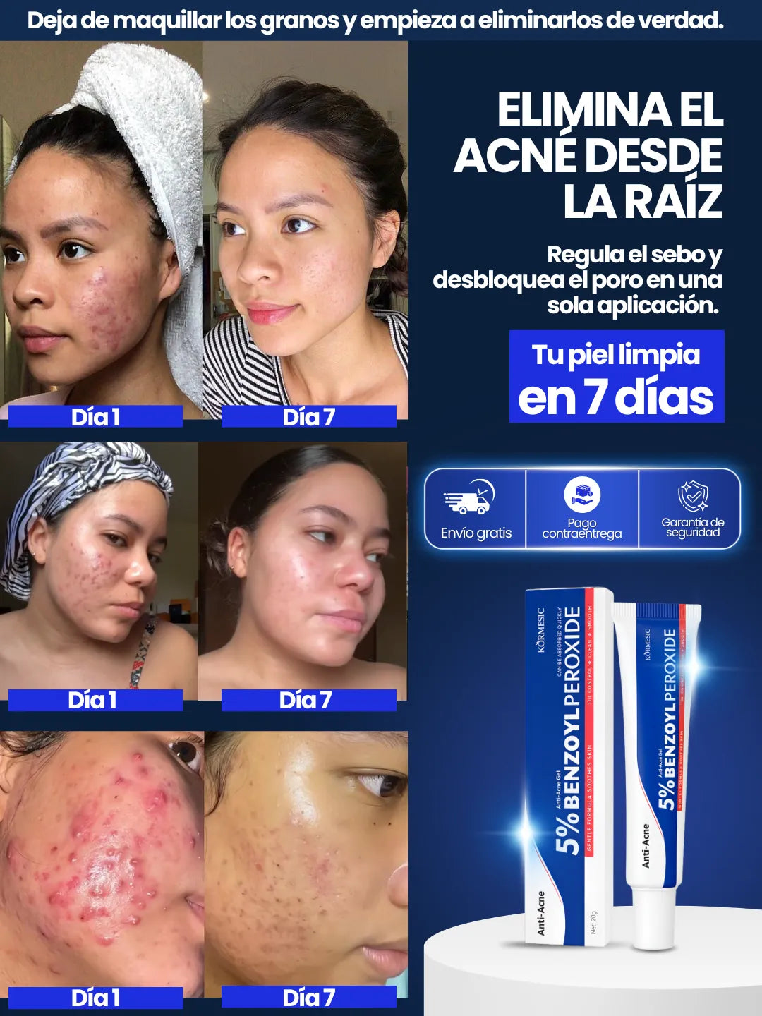 Eliminador de Acné | 5% BENZOYL PEROXIDE